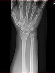 2018.1.24撮影 レントゲン写真 右下腕部のレントゲン写真